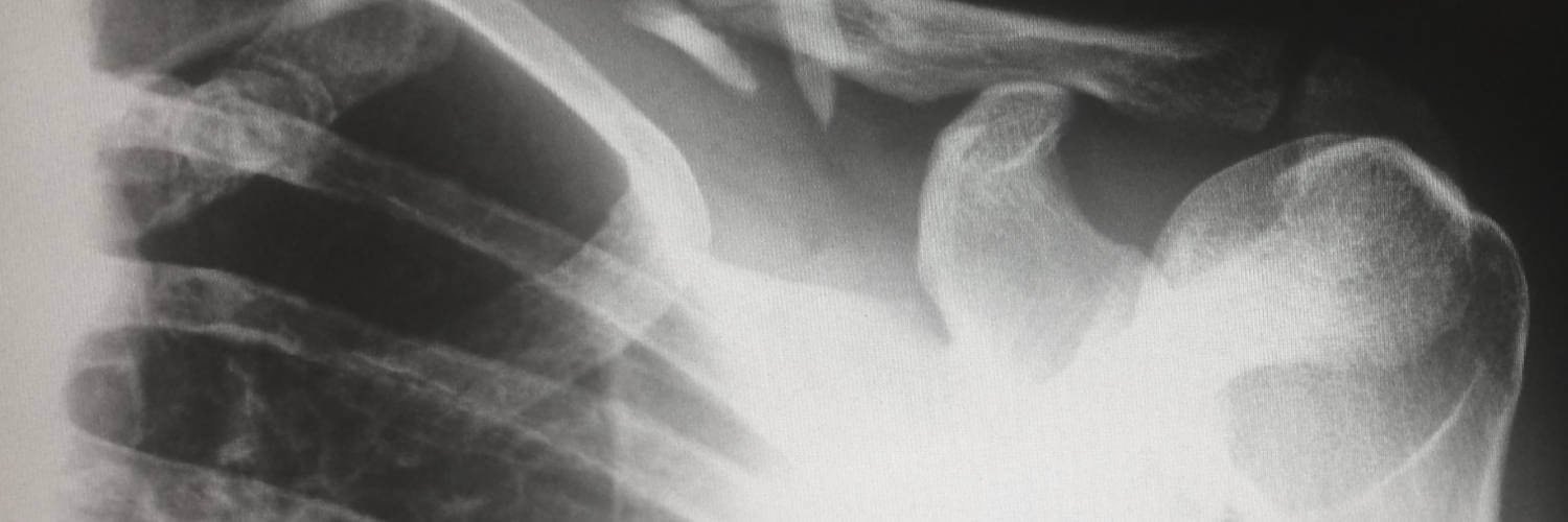 Does High Dose Calcium Prevent Bone Fractures? MigreLief